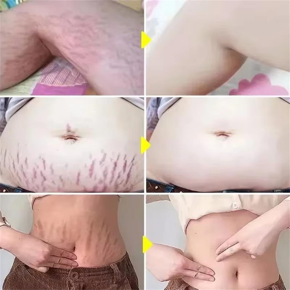 100g Çatlak İzlerini Kalıcı Ol - Teeth Whitening Pregnancy incelemesi ve fiyatı